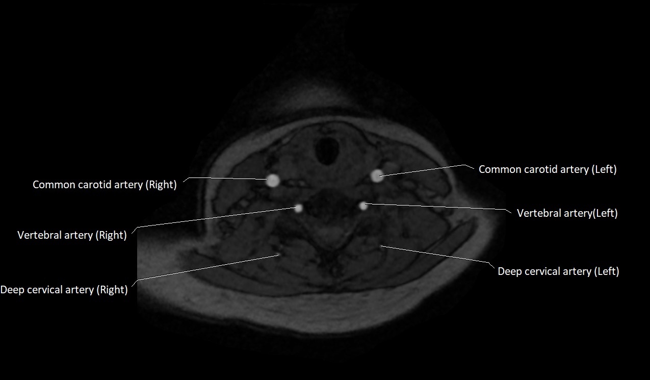 Carotid artery anatomy axial 3T image 44.jpg